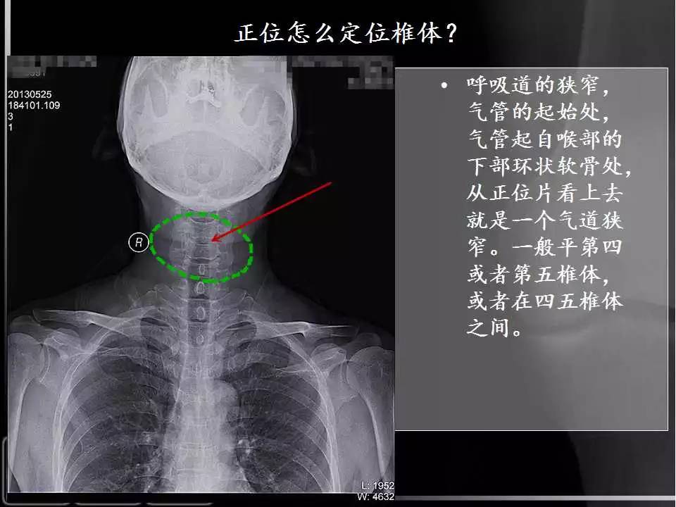 正常颈椎dr图片图片