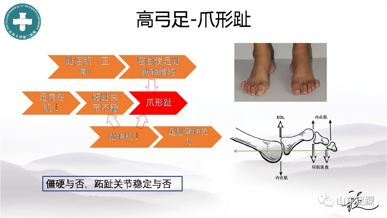 高弓足的基本病理特點及診療策略