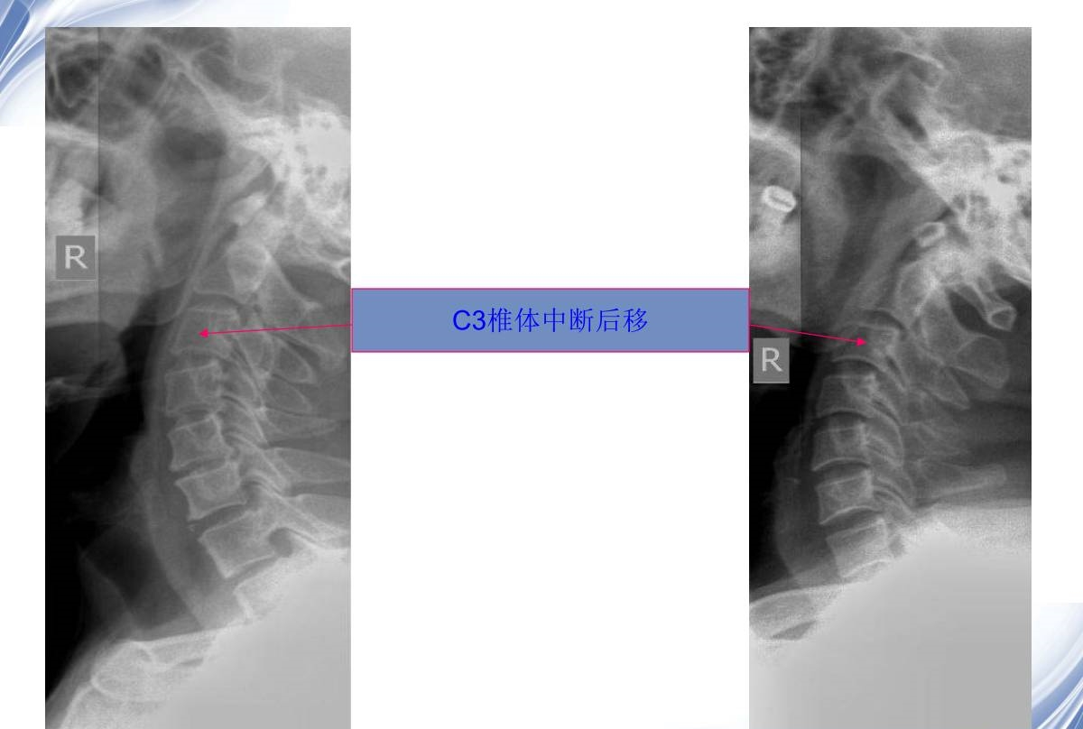 颈椎x线诊断的内容及其解读