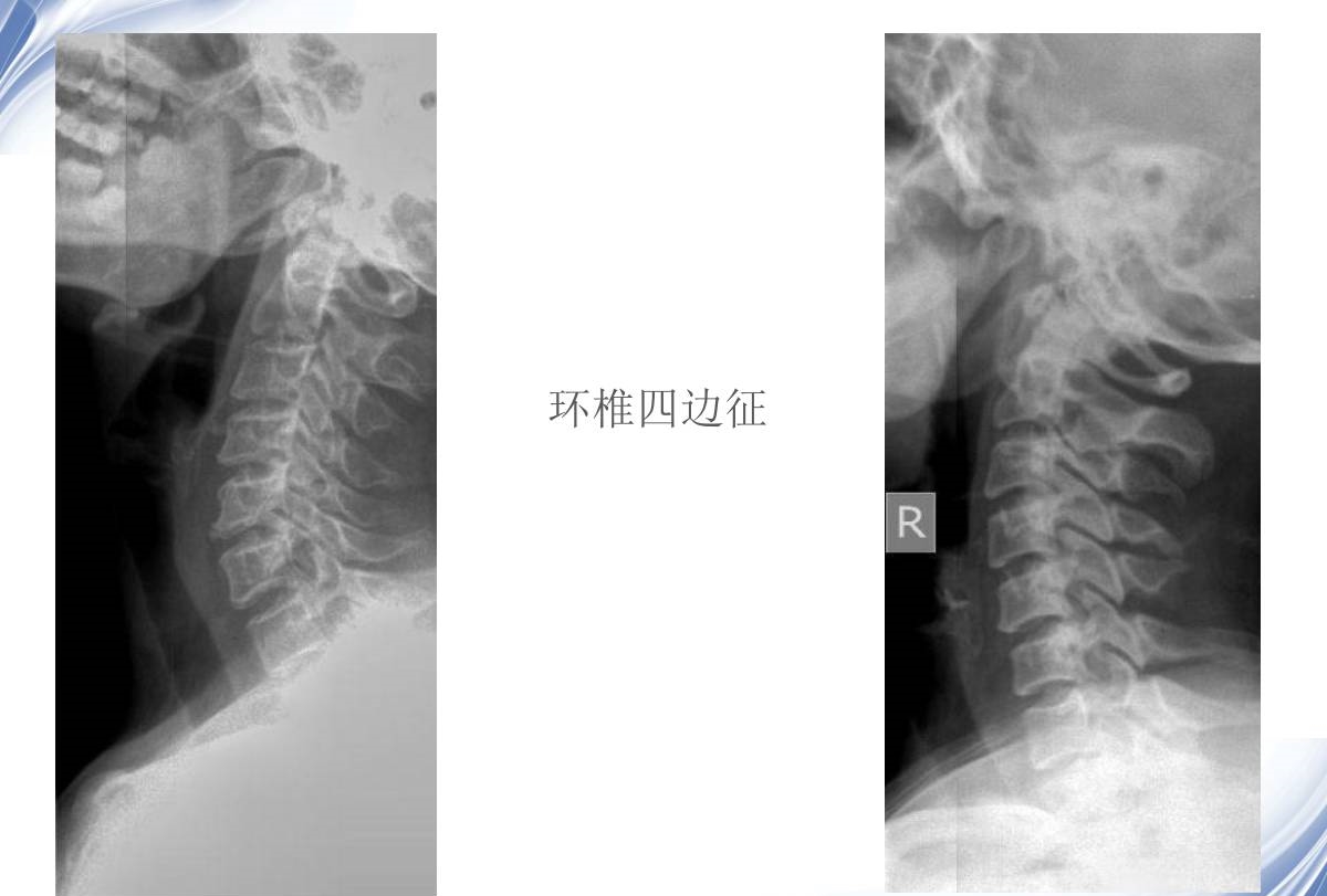 頸椎x線診斷的內容及其解讀 - 好醫術早讀文章 - 好醫術-賦能醫生守護