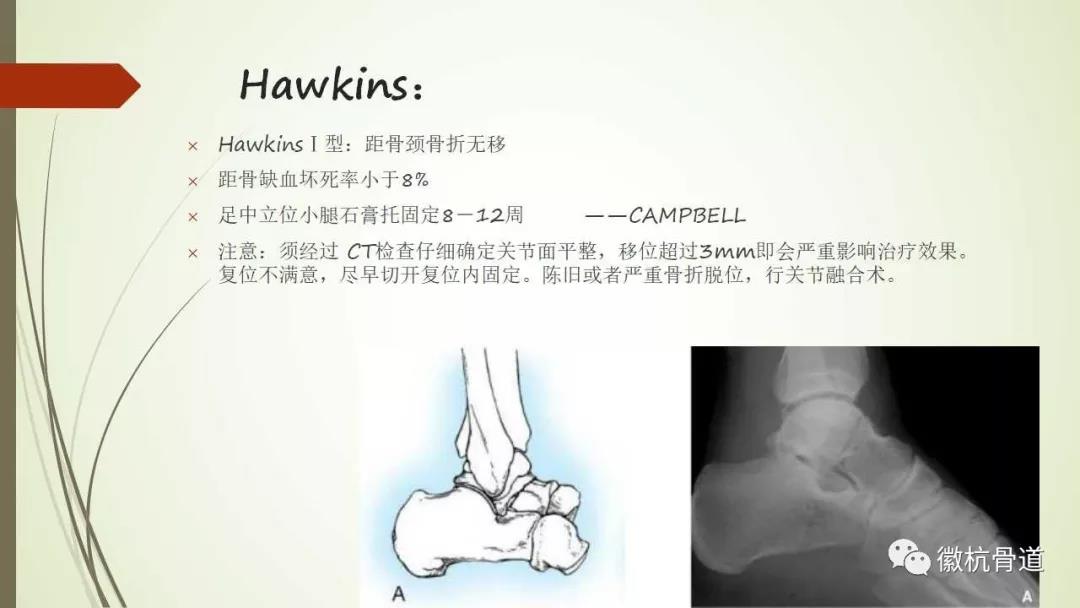 距骨骨折的分型及临床治疗策略