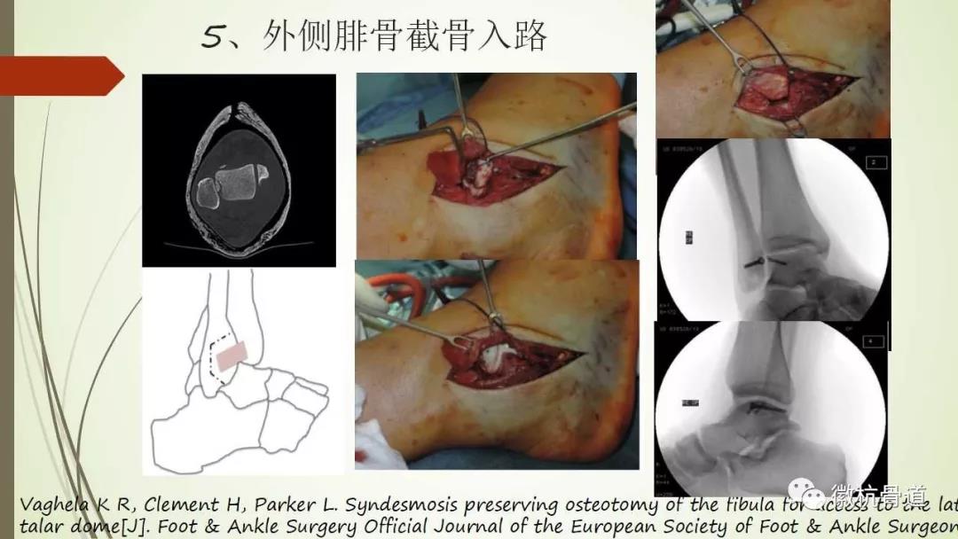 距骨骨折的分型及臨床治療策略