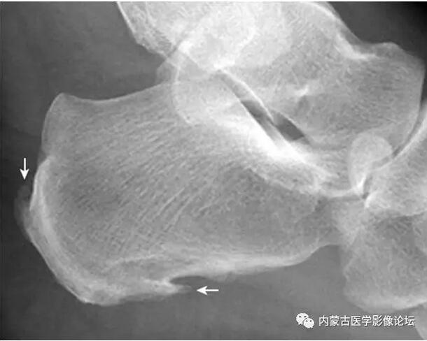 距骨鼻区撕脱骨折:距骨鼻区见小片状骨性密度影,其与距骨对应处见骨质