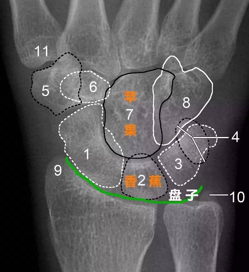 小多角骨 7.頭狀骨 8.鉤骨 9.橈骨莖突 10.尺骨莖突 11.