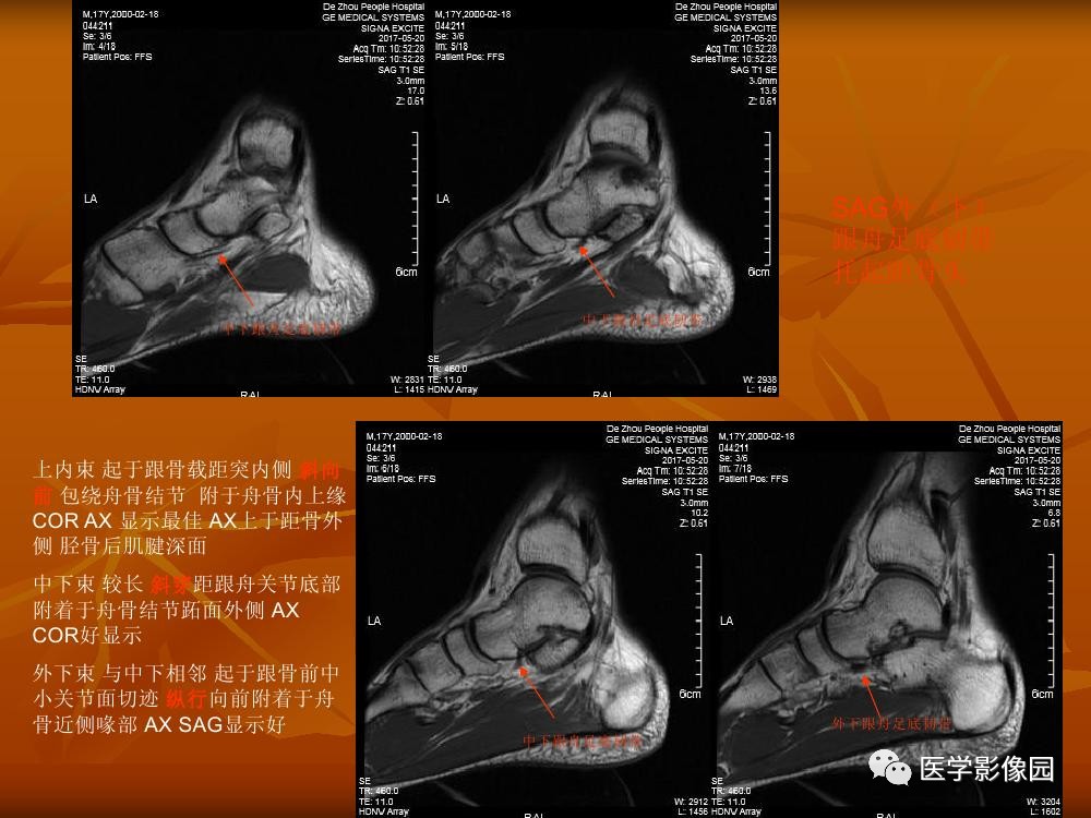 踝关节韧带的解剖及影像表现