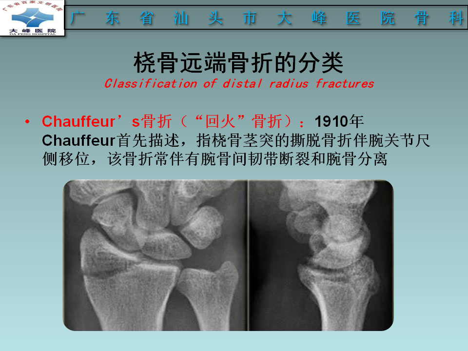 桡骨远端骨折的分型及治疗策略