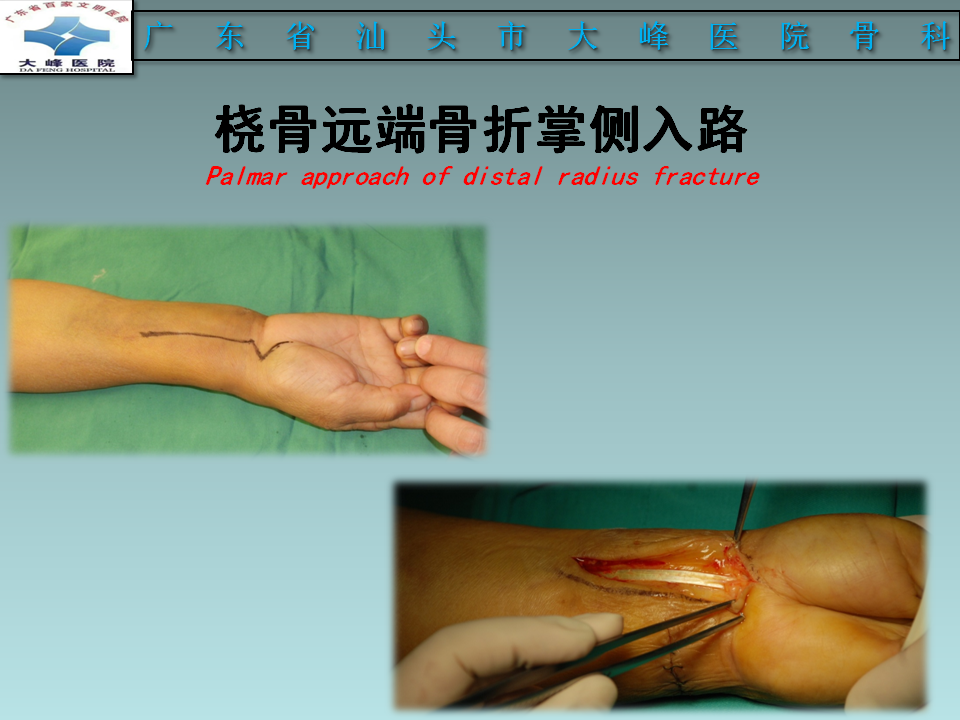 橈骨遠端骨折的分型及治療策略