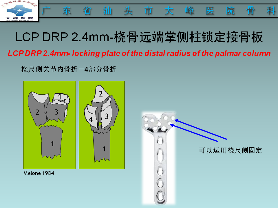 桡骨远端骨折的分型及治疗策略