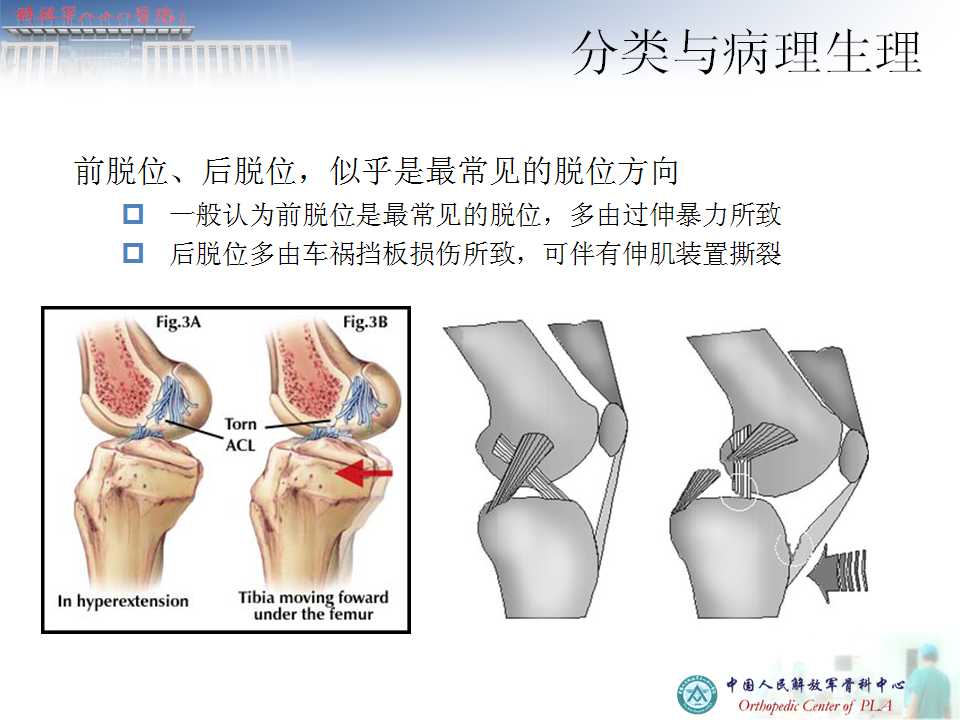 膝關節多韌帶損傷的治療要點