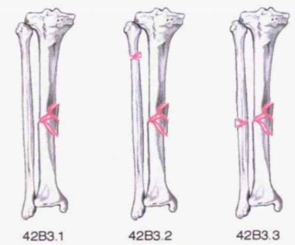 常見四肢骨折分型彙總快快收藏吧