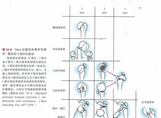 二橈骨小頭骨折mason分型三股骨頸骨折分型(garden分型)garden i型:不