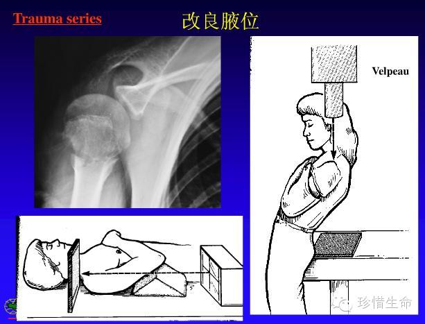 肩關節x線檢查體位大全