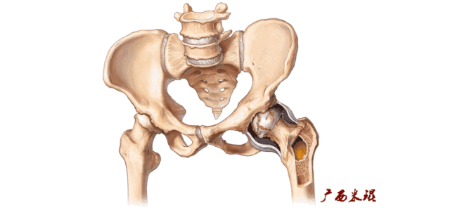 一文读懂:髋关节撞击综合征
