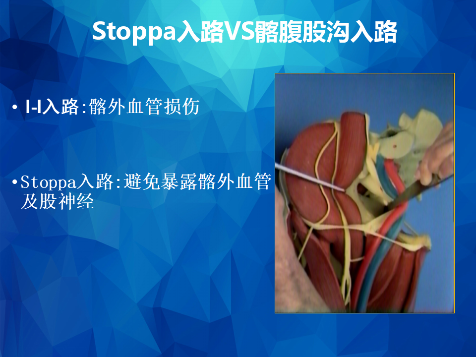 stoppa及其改良入路治疗骨盆髋臼骨折
