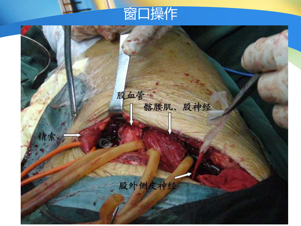 骨盆髋臼骨折如何选择手术入路?