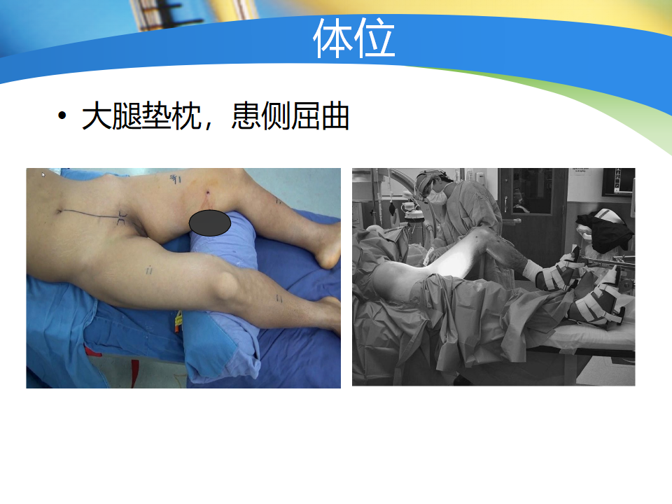 骨盆髋臼骨折如何选择手术入路?