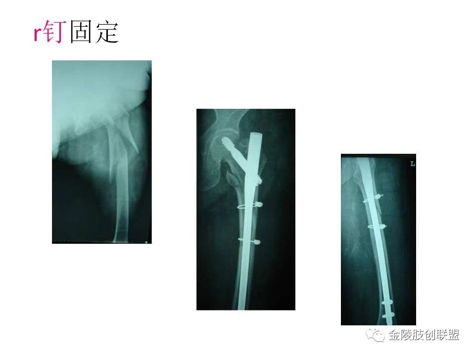 股骨转子间骨折的分型及内固定选择