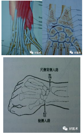 進針點:橈,尺骨莖突遠端背側;橈骨遠端背側關節面邊緣關 節:手掌朝