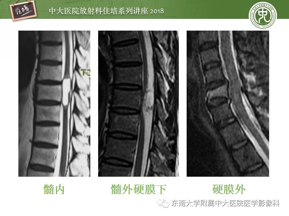 8个病例详解「脊髓内最常见疾病」的mr诊断