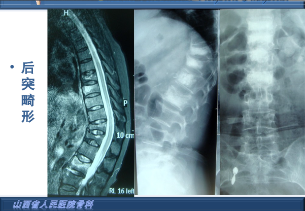 透彻解析骨质疏松椎体压缩性骨折的治疗策略