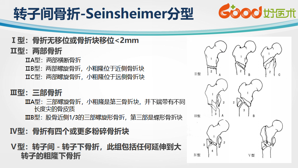 本课件中,周方教授介绍了股骨转子间骨折的定义,分型及诊疗技巧,同时