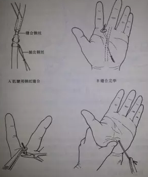 肌腱止于骨上的缝合参考文献:99顾玉东等,手外科手术学 上海:上海