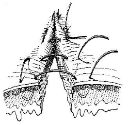 (4)连续水平褥式浆肌层内翻缝合法:又称库兴氏(cushing)缝合法,如膀胱