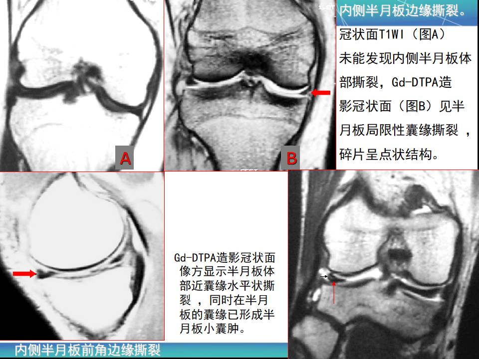 膝关节半月板mri诊断 看这篇就够了 好医术早读文章 好医术 赋能医生守护生命