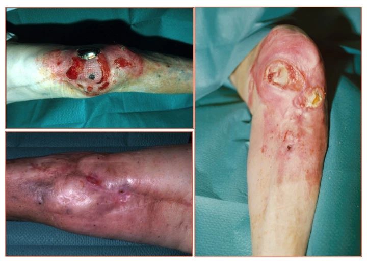 人工关节术后假体周围感染的诊断及治疗策略