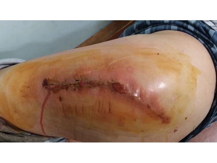 人工关节术后假体周围感染的诊断及治疗策略