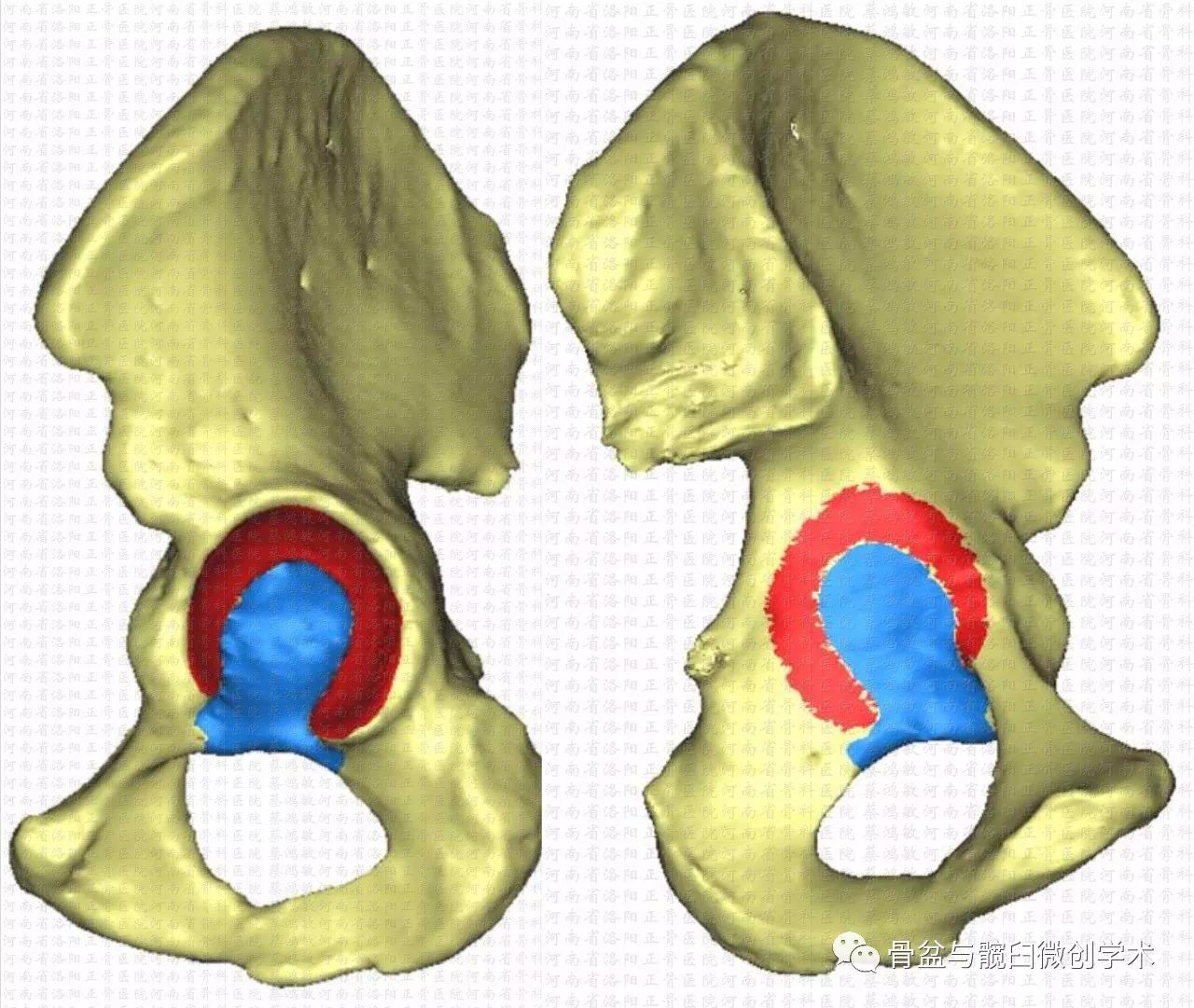 图4-7 髋关节的韧带(冠状切面)-骨科临床解剖学-医学