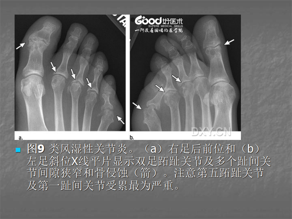 關節炎的x線評價太全面了