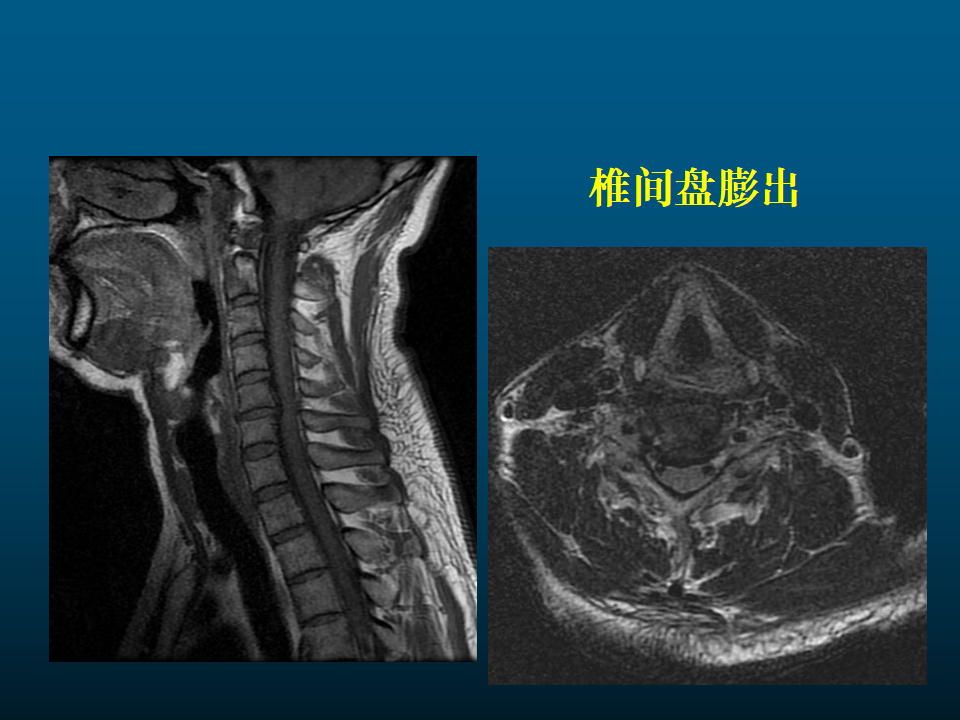 一篇课件详解颈椎病的mri诊断技巧
