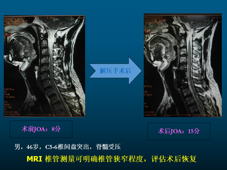 一篇课件详解颈椎病的mri诊断技巧