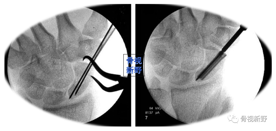 舟狀骨骨折掌側經皮螺釘固定術