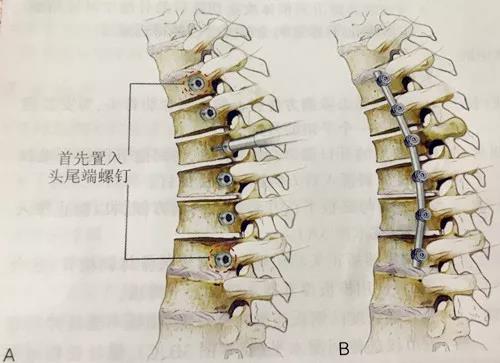 一篇掌握:腰椎前路椎体切除术手术技巧