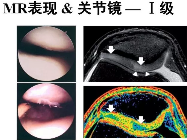 一篇掌握:髕骨軟化症的影像學診斷!