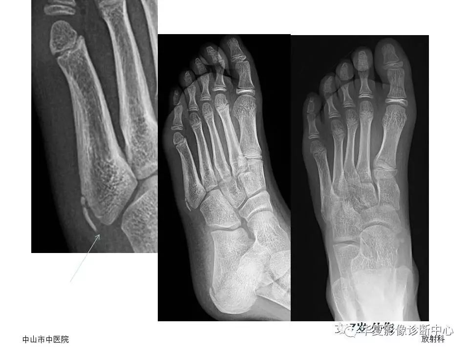 籽骨副骨及永存骨骺常見請不要誤診