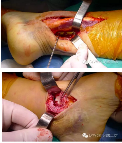 三角韧带损伤问题的最全总结看这篇