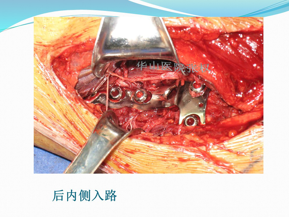 一篇掌握:後方入路治療脛骨平臺骨折