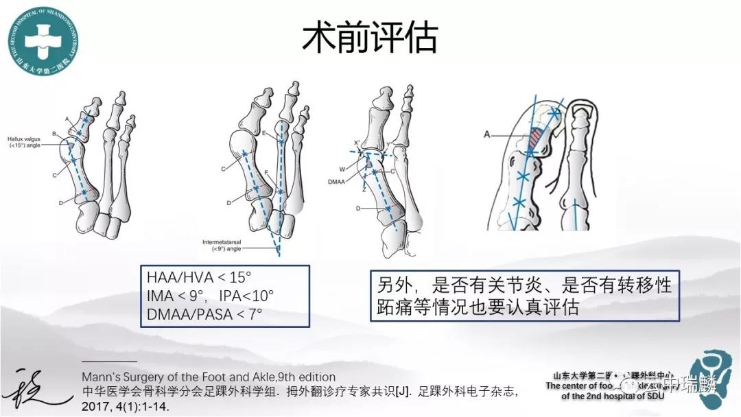 拇外翻测量角度图片,拇外翻图片_大山谷图库