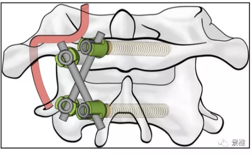 寰樞椎後路固定的方式很多,這次是c1-2椎板螺釘和椎弓根釘的交叉固定.