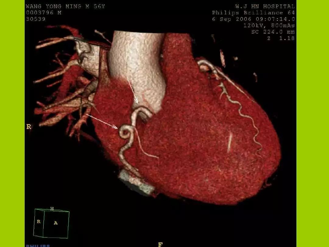 冠状动脉CT血管成像最新临床应用推荐及诊断规范 - 中华放射学杂志