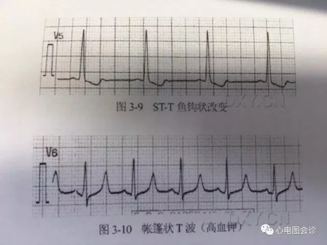 ST-T 改变的临床意义 - 好医术早读文章 - 好医术-赋能医生守护生命