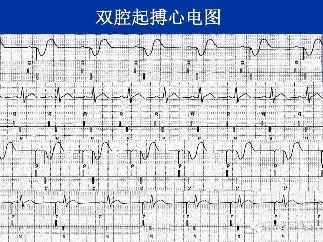 心室起搏心电图特点图片