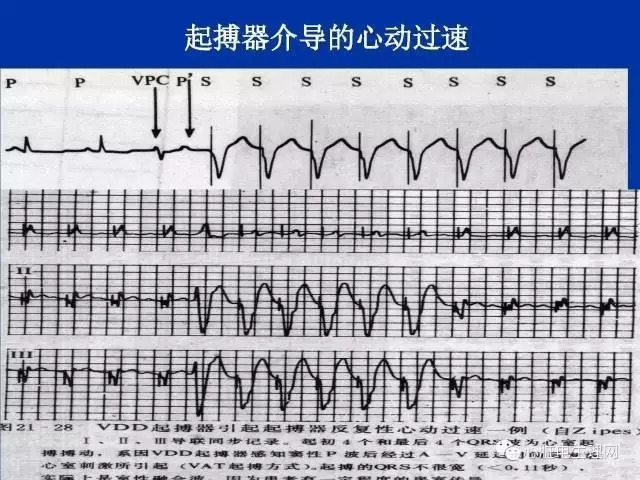 心室起搏心电图特点图片