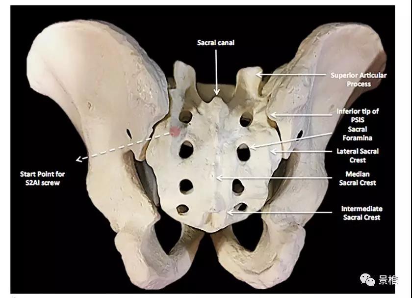 s2骶髂螺釘的徒手置入技術,詳細講解!