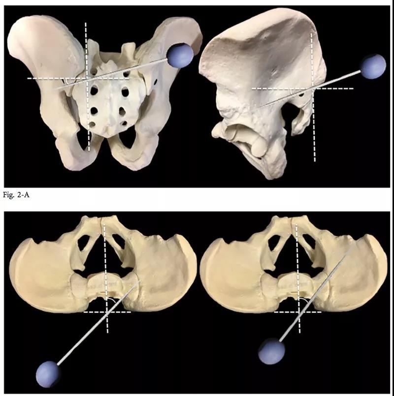 s2骶髂螺釘的徒手置入技術,詳細講解!