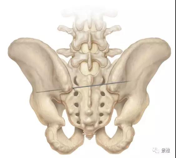 標準的置釘示意圖部分圖片來自depuy技術手冊