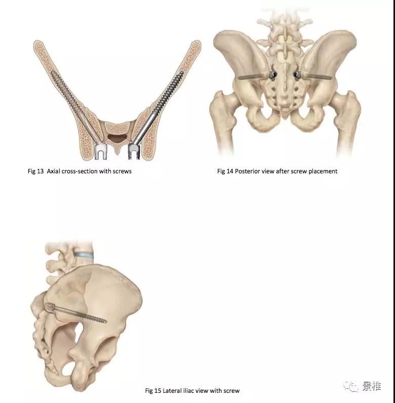 s2骶髂螺釘的徒手置入技術,詳細講解!